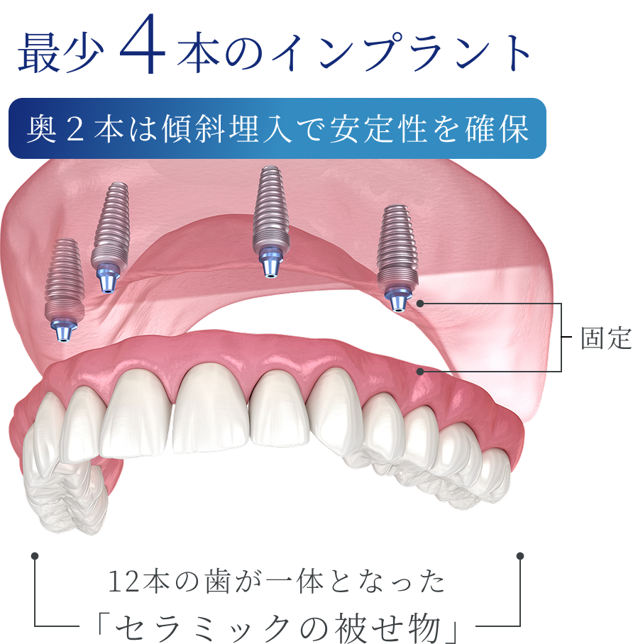 最少本のインプラント奥２本は傾斜埋入で安定性を確保