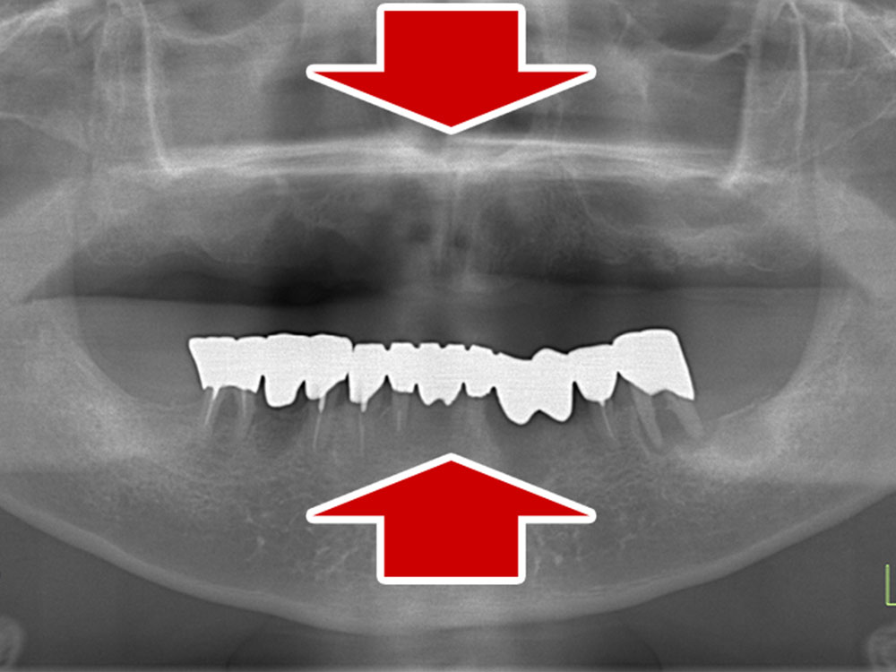 上顎6本（オールオン６） 下顎3本