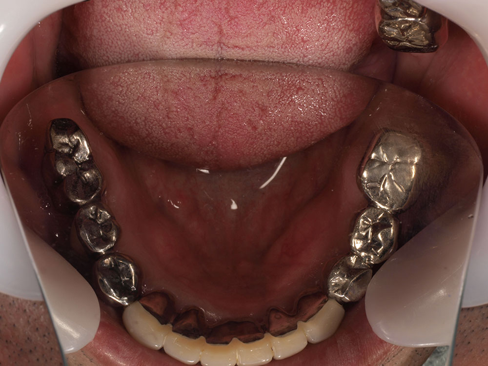 上顎6本（オールオン６） 下顎3本