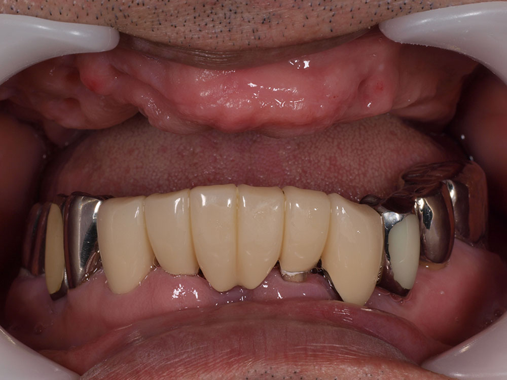 上顎6本（オールオン６） 下顎3本