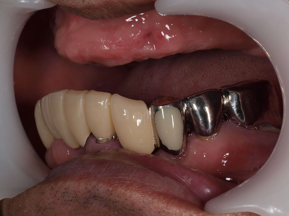 上顎6本（オールオン６） 下顎3本