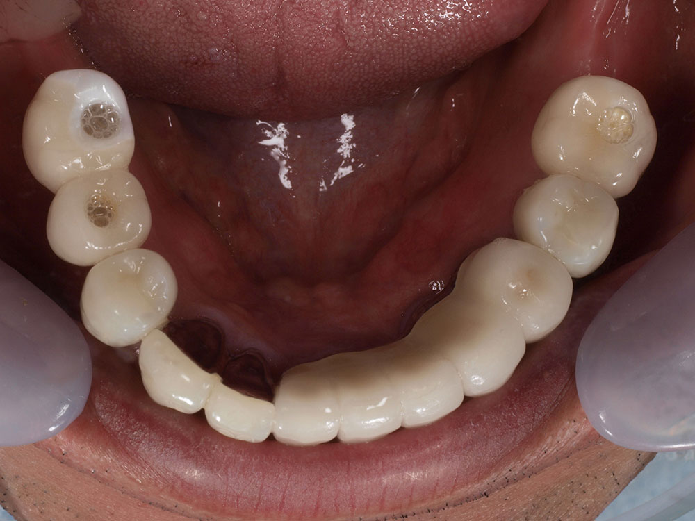 上顎6本（オールオン６） 下顎3本