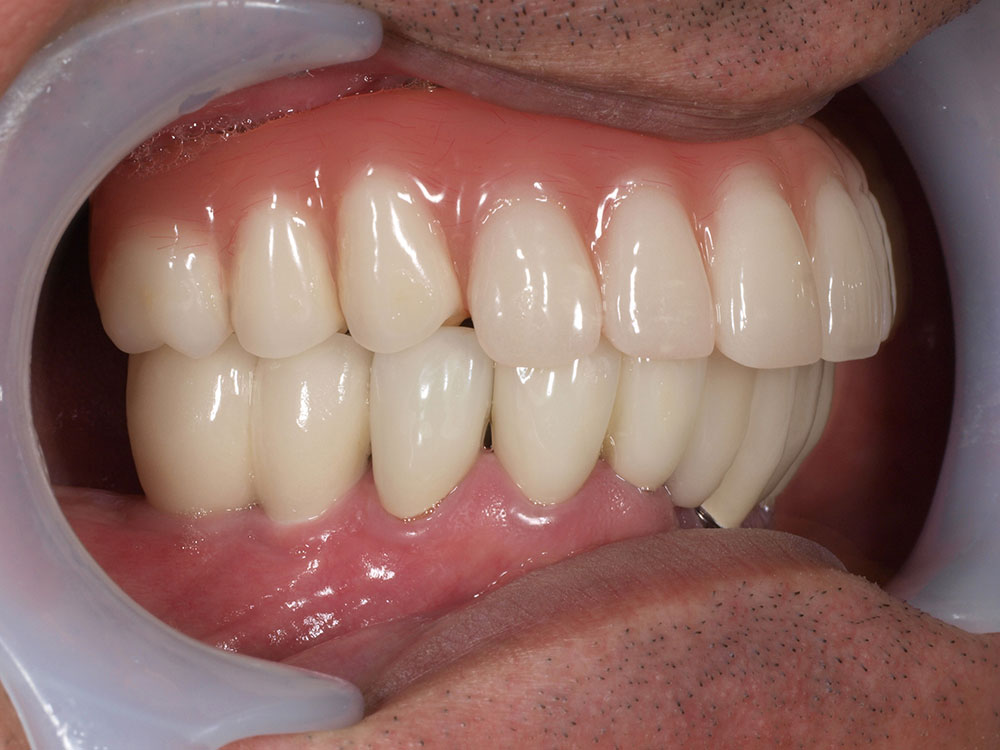 上顎6本（オールオン６） 下顎3本