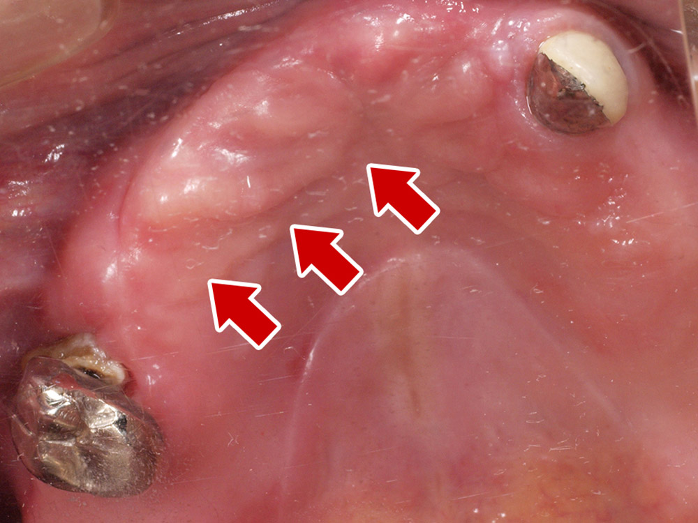 上顎4本で12歯（オールオン４）、下顎4本5歯