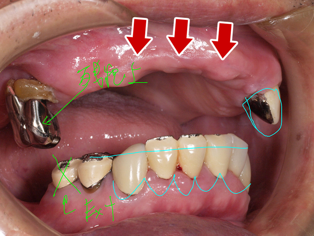 上顎4本で12歯（オールオン４）、下顎4本5歯