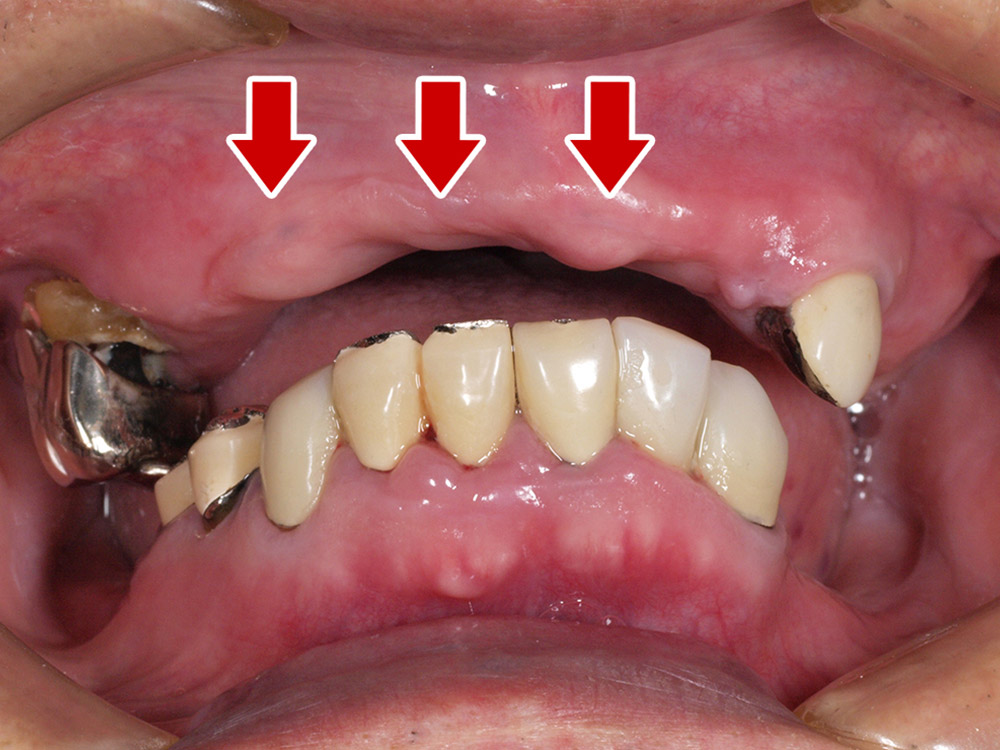 上顎4本で12歯（オールオン４）、下顎4本5歯