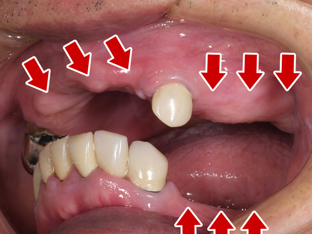 上顎4本で12歯（オールオン４）、下顎4本5歯