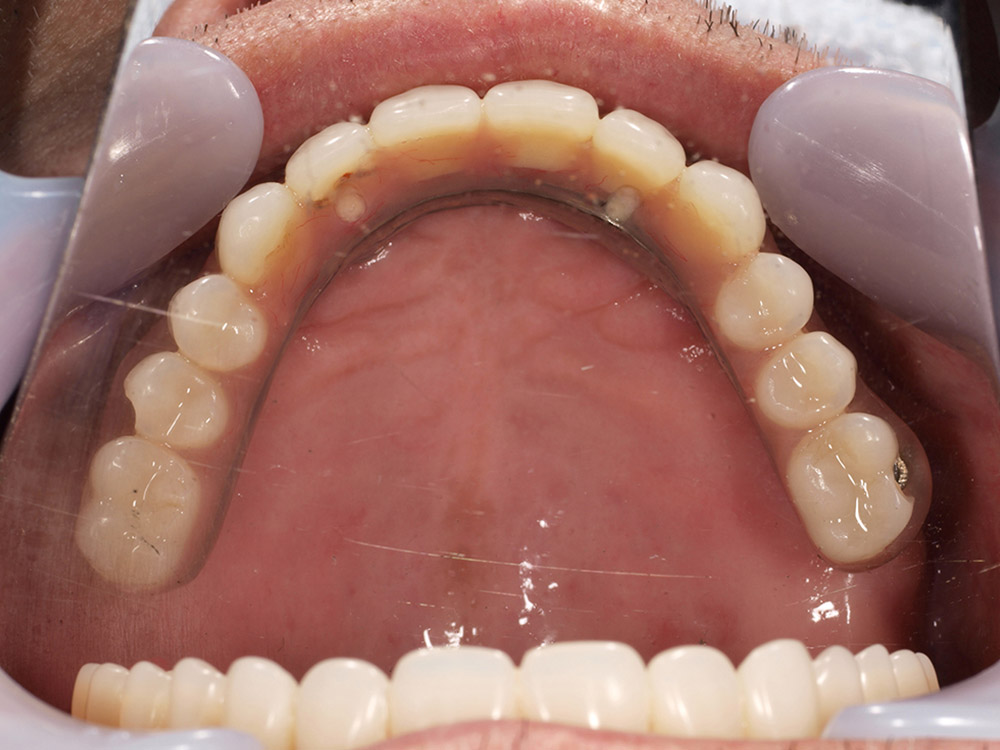 上顎4本で12歯（オールオン４）、下顎4本5歯