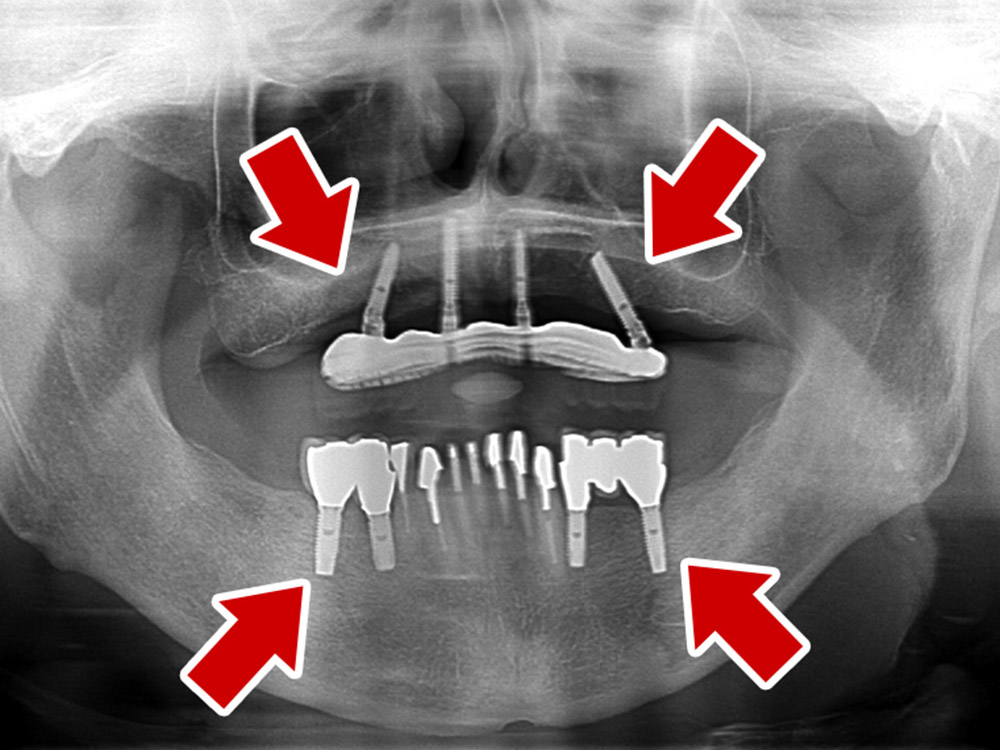 上顎4本で12歯（オールオン４）、下顎4本5歯