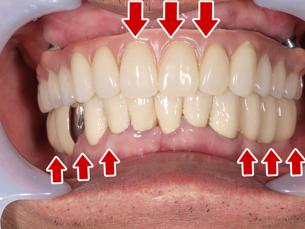 上顎4本で12歯（オールオン４）、下顎4本5歯