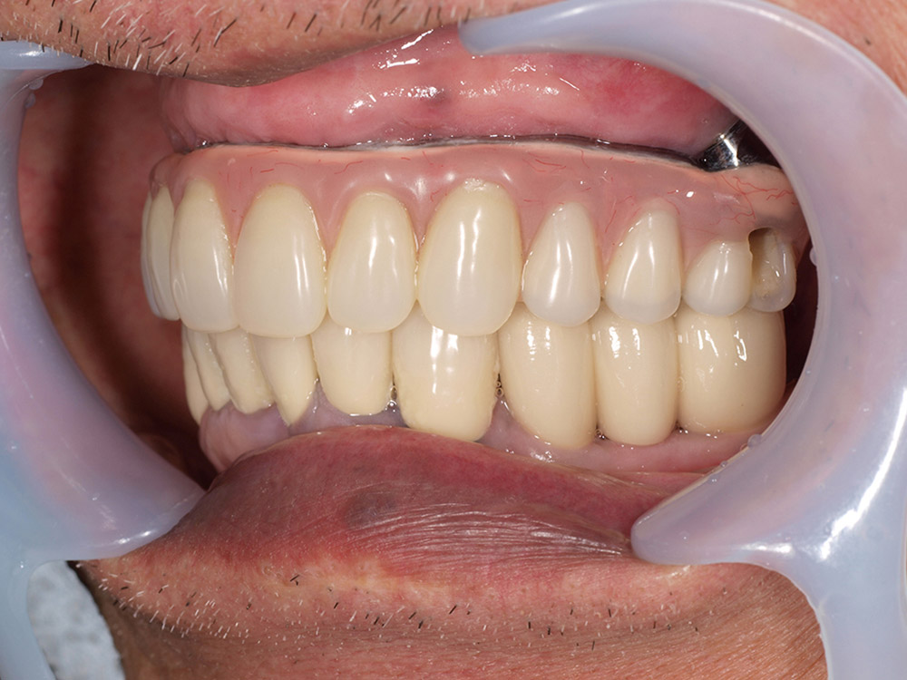 上顎4本で12歯（オールオン４）、下顎4本5歯