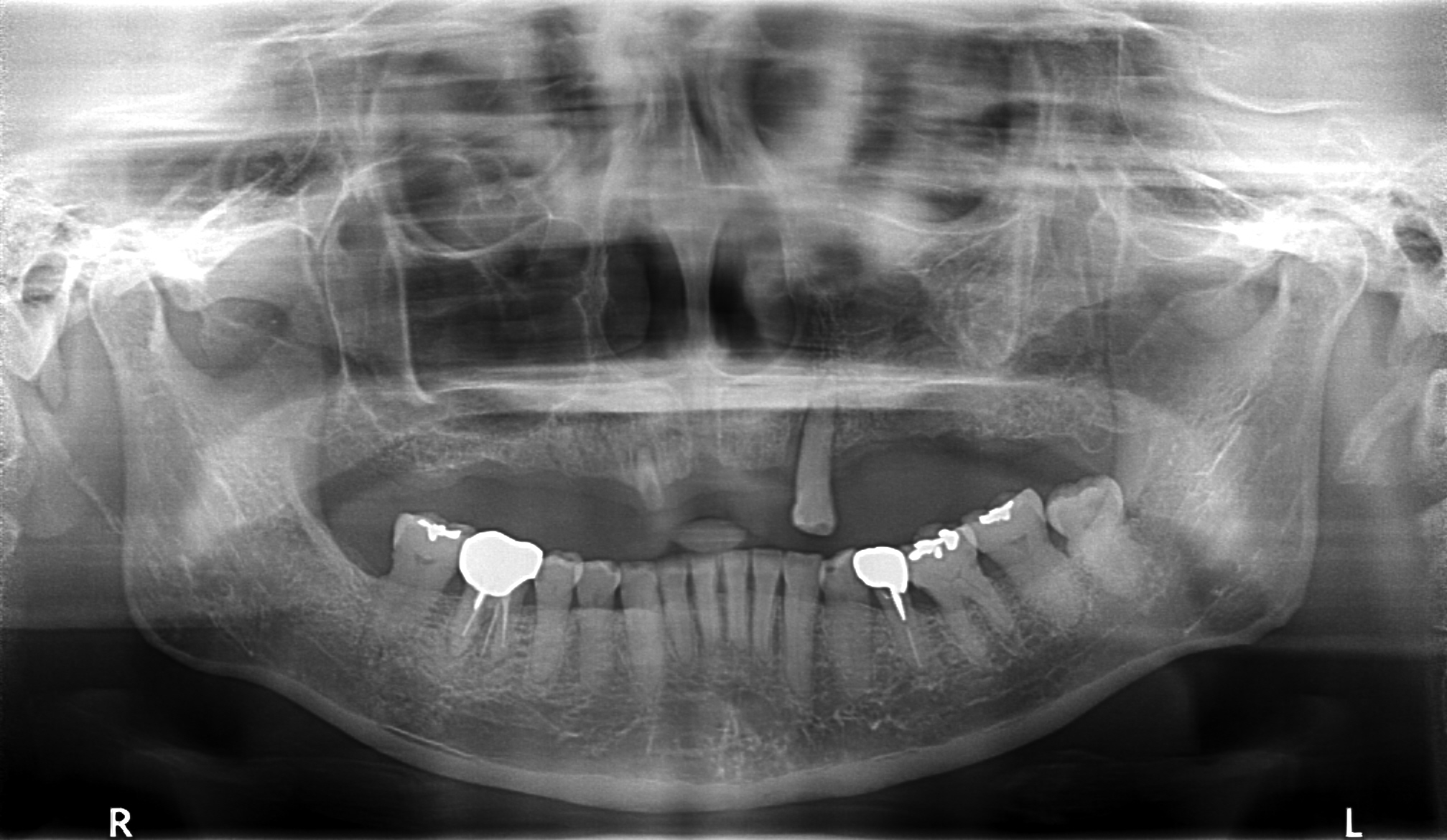 上顎4本で12歯（オールオン４）、下顎4本5歯