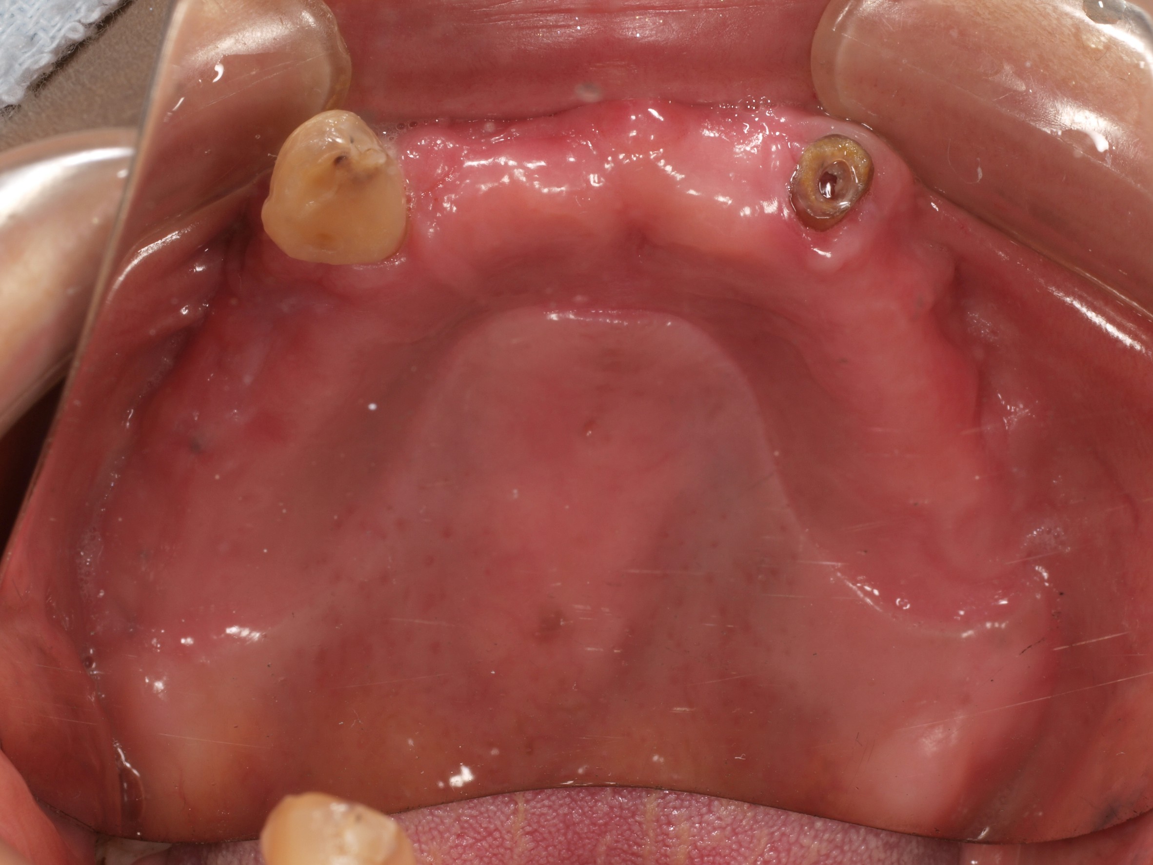 上顎4本で12歯（オールオン４）、下顎4本5歯