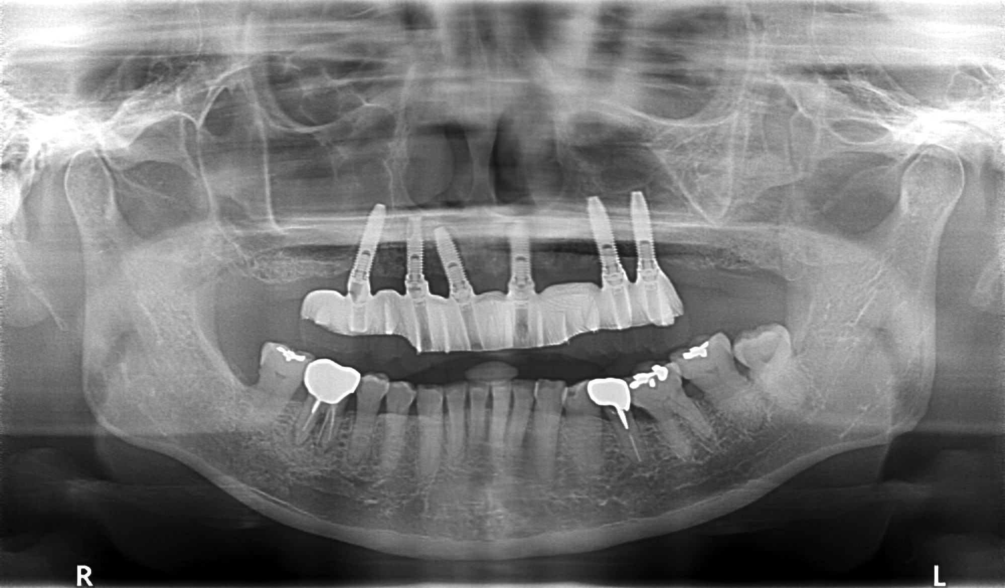 上顎4本で12歯（オールオン４）、下顎4本5歯