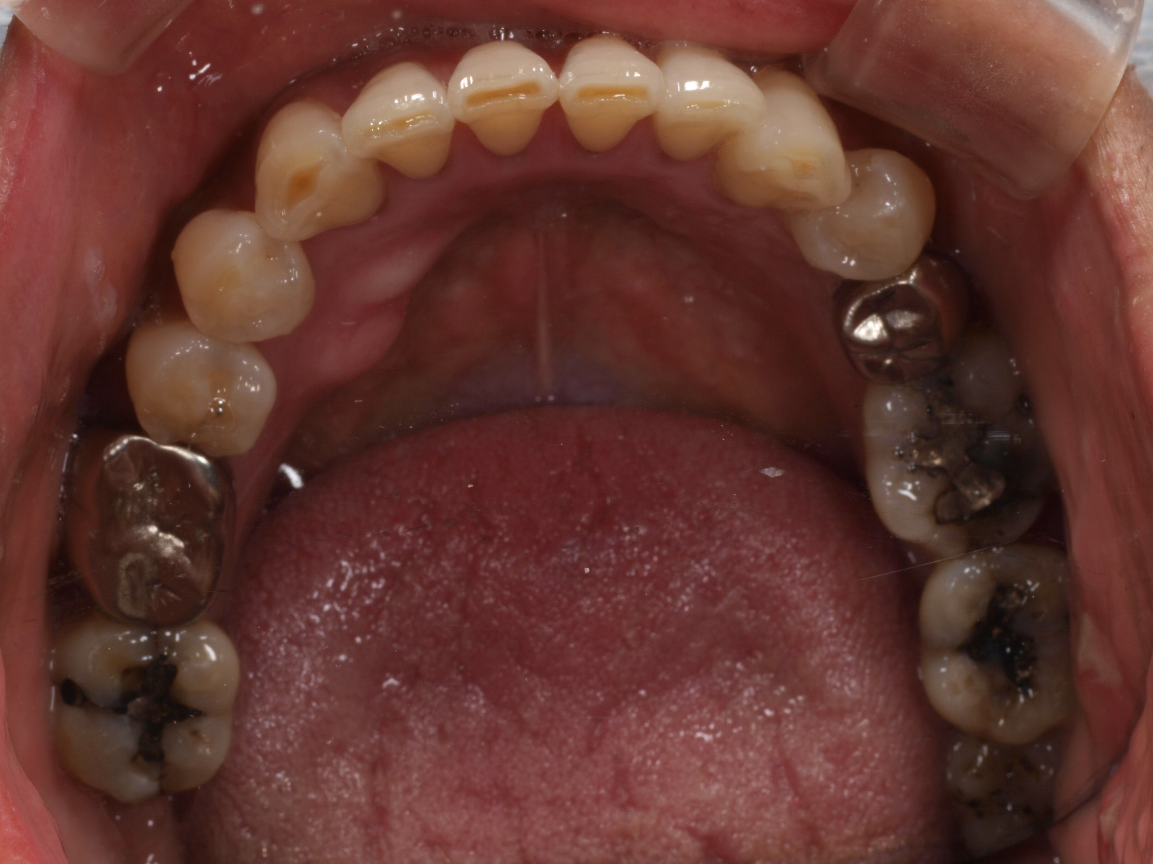 上顎4本で12歯（オールオン４）、下顎4本5歯