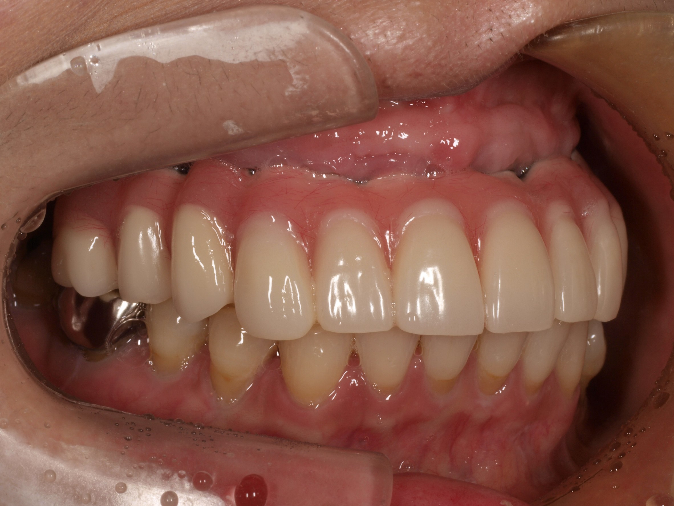 上顎4本で12歯（オールオン４）、下顎4本5歯