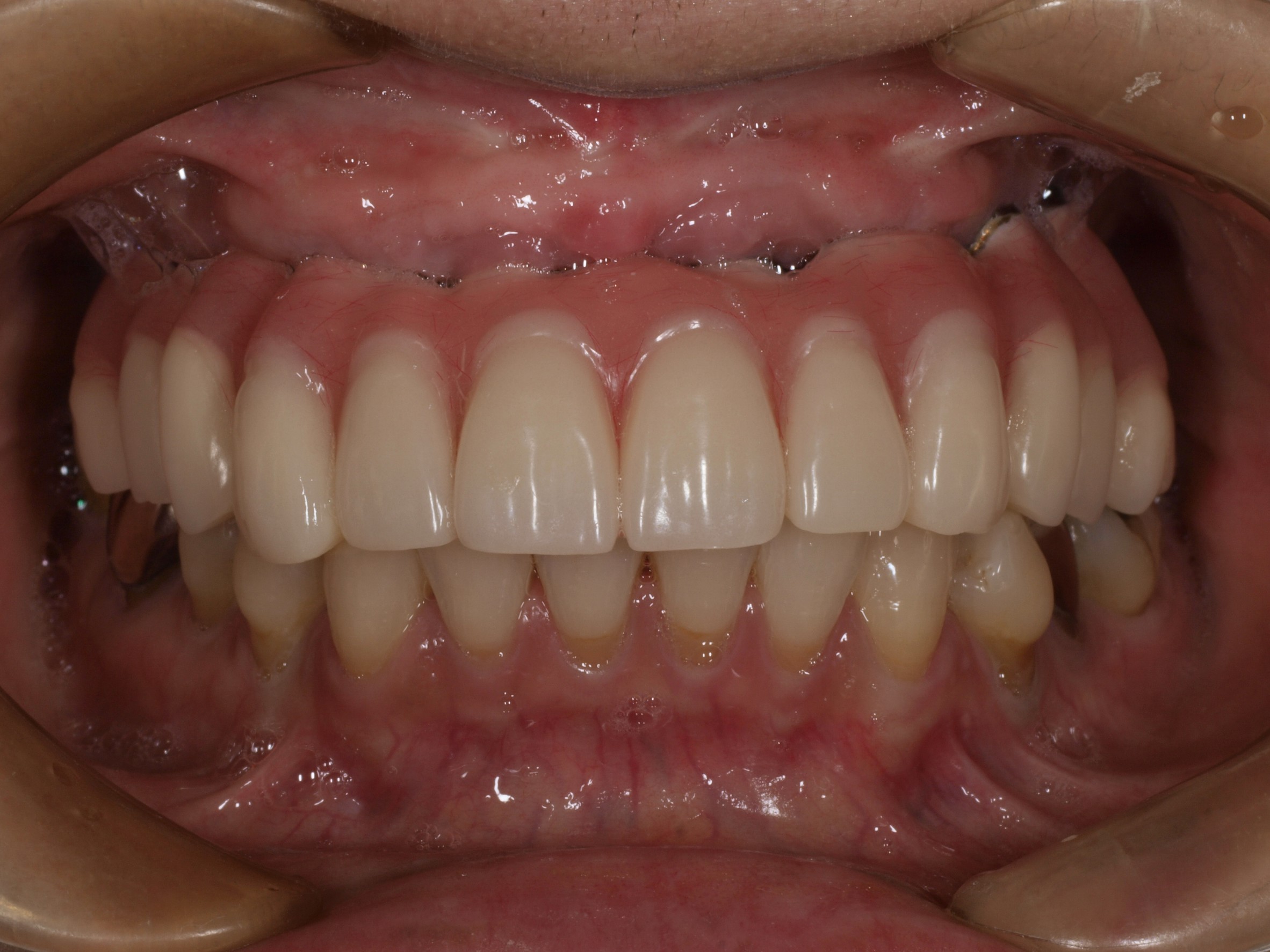 上顎4本で12歯（オールオン４）、下顎4本5歯