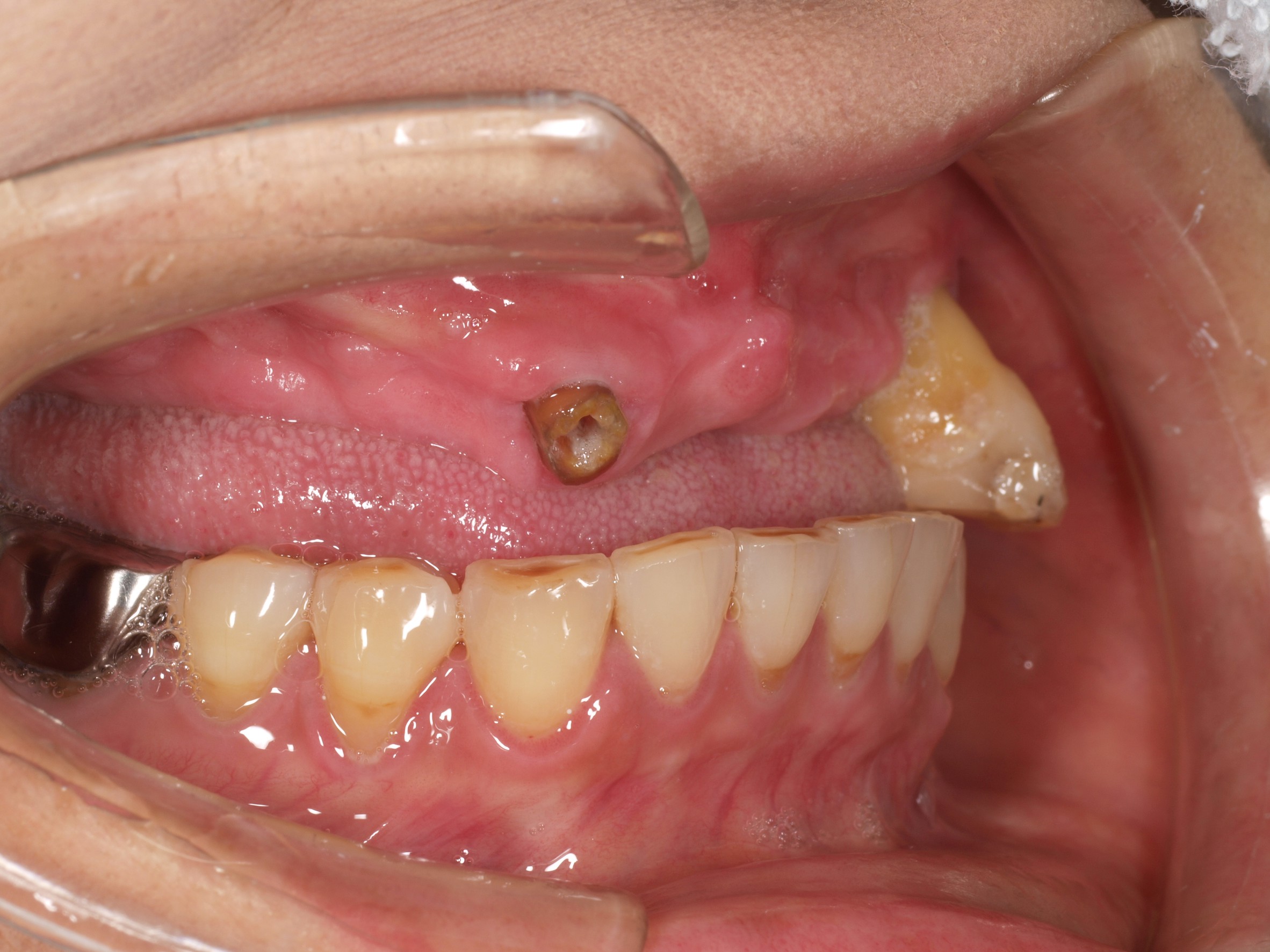 上顎4本で12歯（オールオン４）、下顎4本5歯