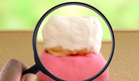 プラーク（歯垢）の蓄積