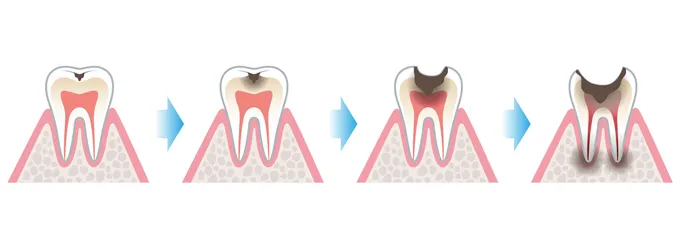 虫歯ができる原因をおさらい