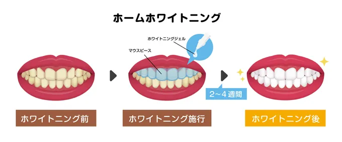 歯を白く保ちたい場合は歯医者でのホワイトニングがおすすめ
