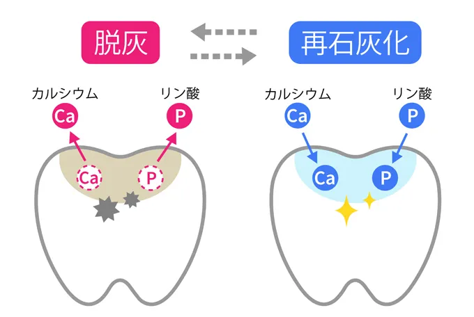 虫歯予防は再石灰化の促進が大切!今日からできる取り組み3つ