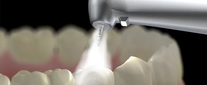 歯を削る量が多い