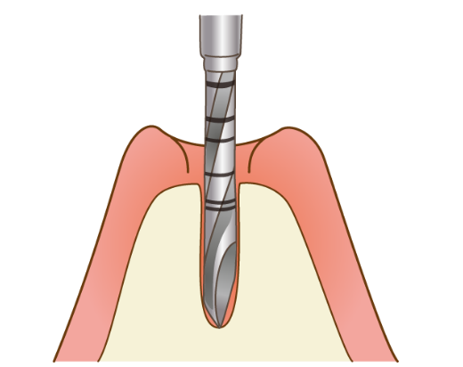 スプリットクレスト
