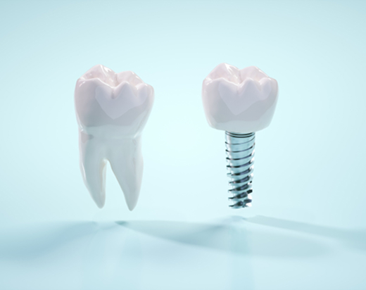 インプラントの基本構造と素材