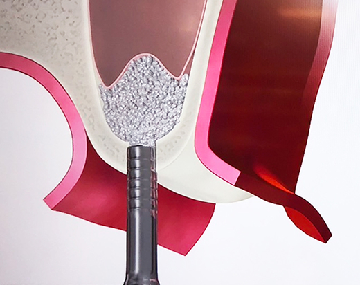 ソケットリフト法（オステオトーム法）とは