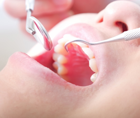 歯周外科・歯周再生療法で歯を残す