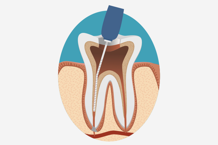 汚れた歯質洗浄