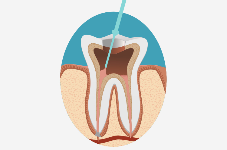 再度薬剤で洗浄